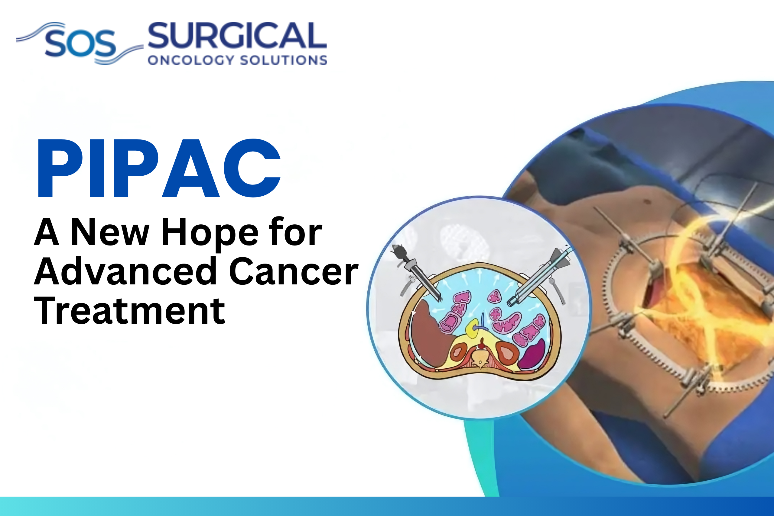PIPAC: A New Hope for Advanced Cancer Treatment