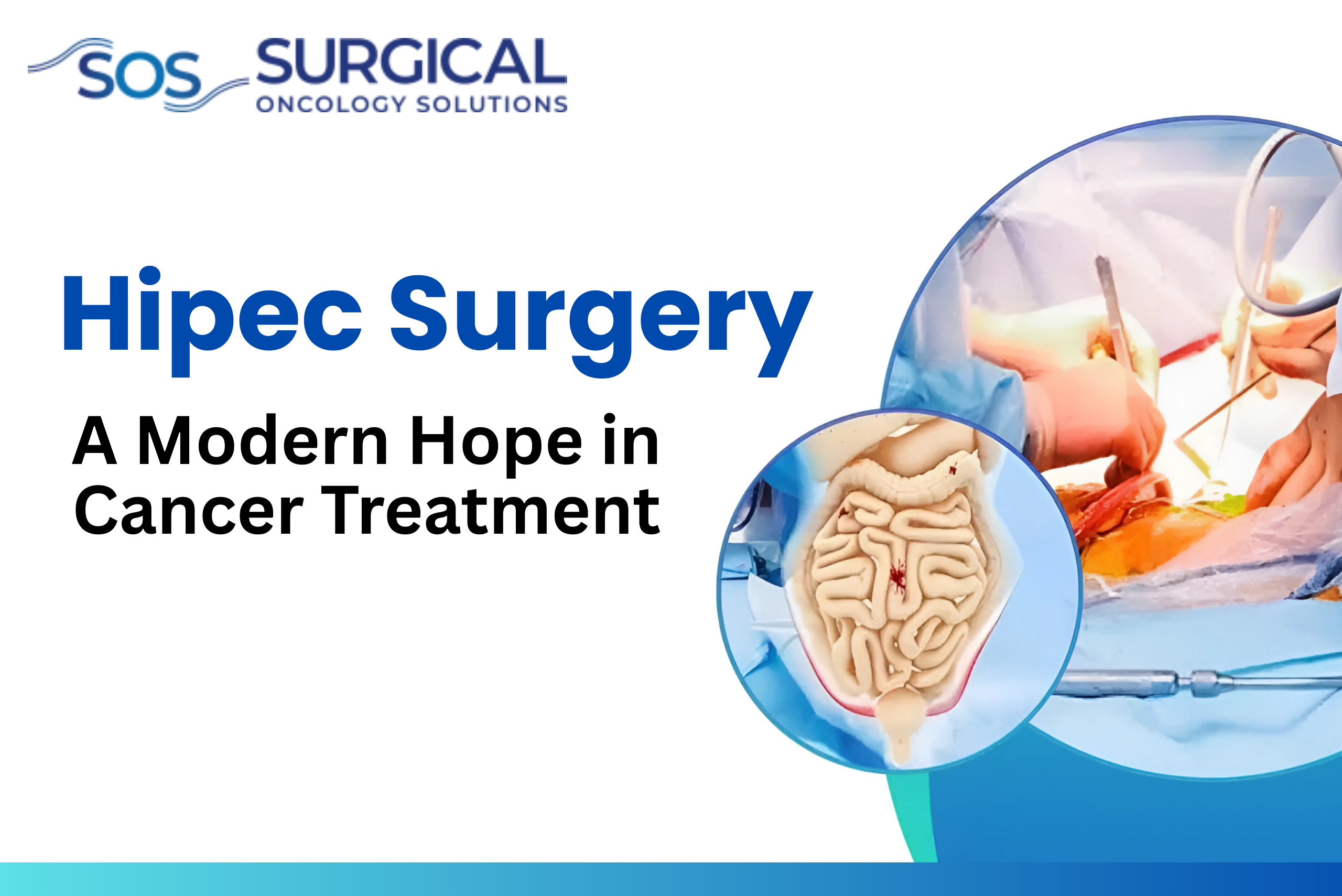 HIPEC Surgery: A Modern Hope in Cancer Treatment