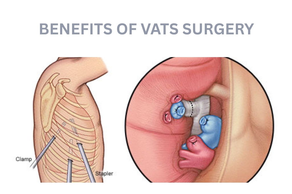 VATS Surgery: benefits,side effects & recovery time