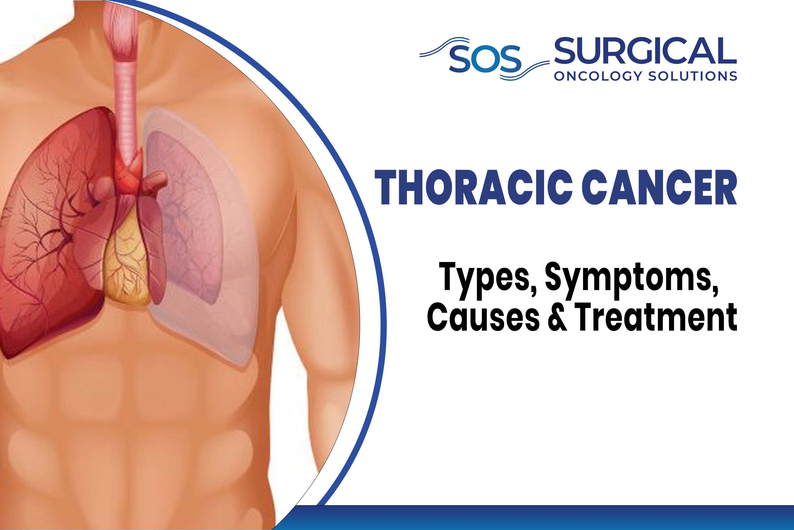 Thoracic Cancer: Types, Symptoms, Causes & Treatment