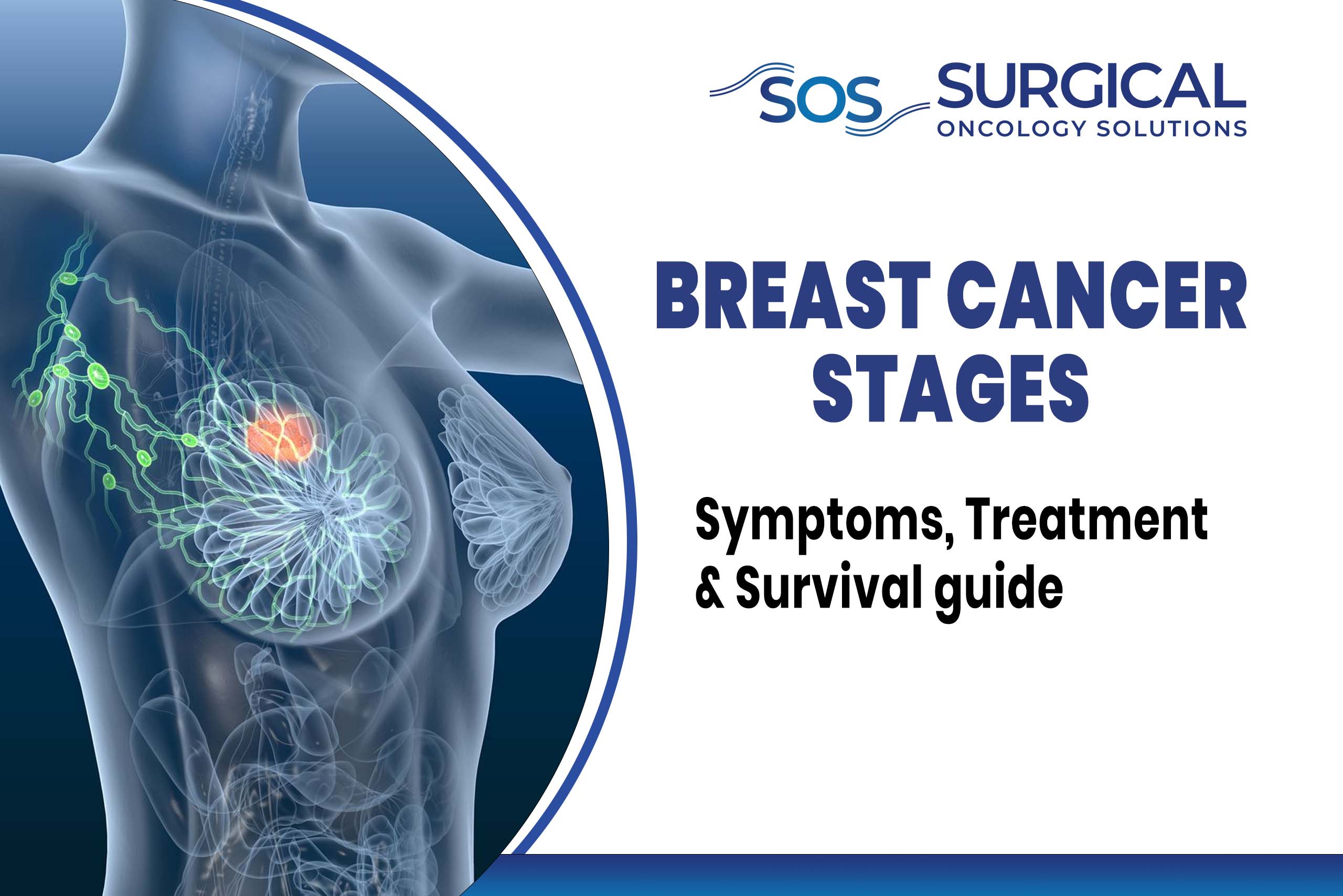 Breast Cancer Stages: Symptoms, Treatment & Survival guide