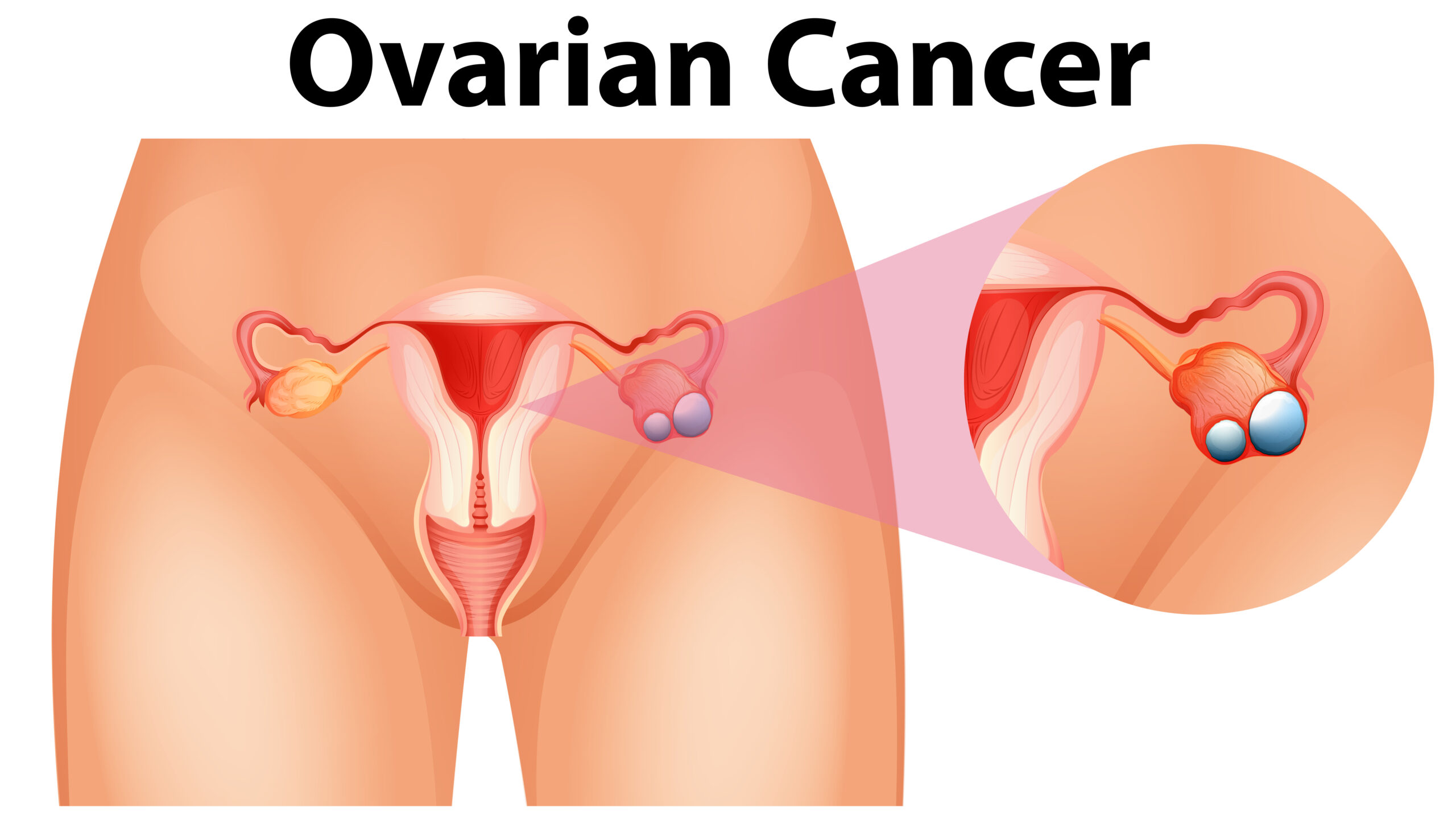 Ovarian Cancer Stages: Symptoms, Treatment & Survival Guide