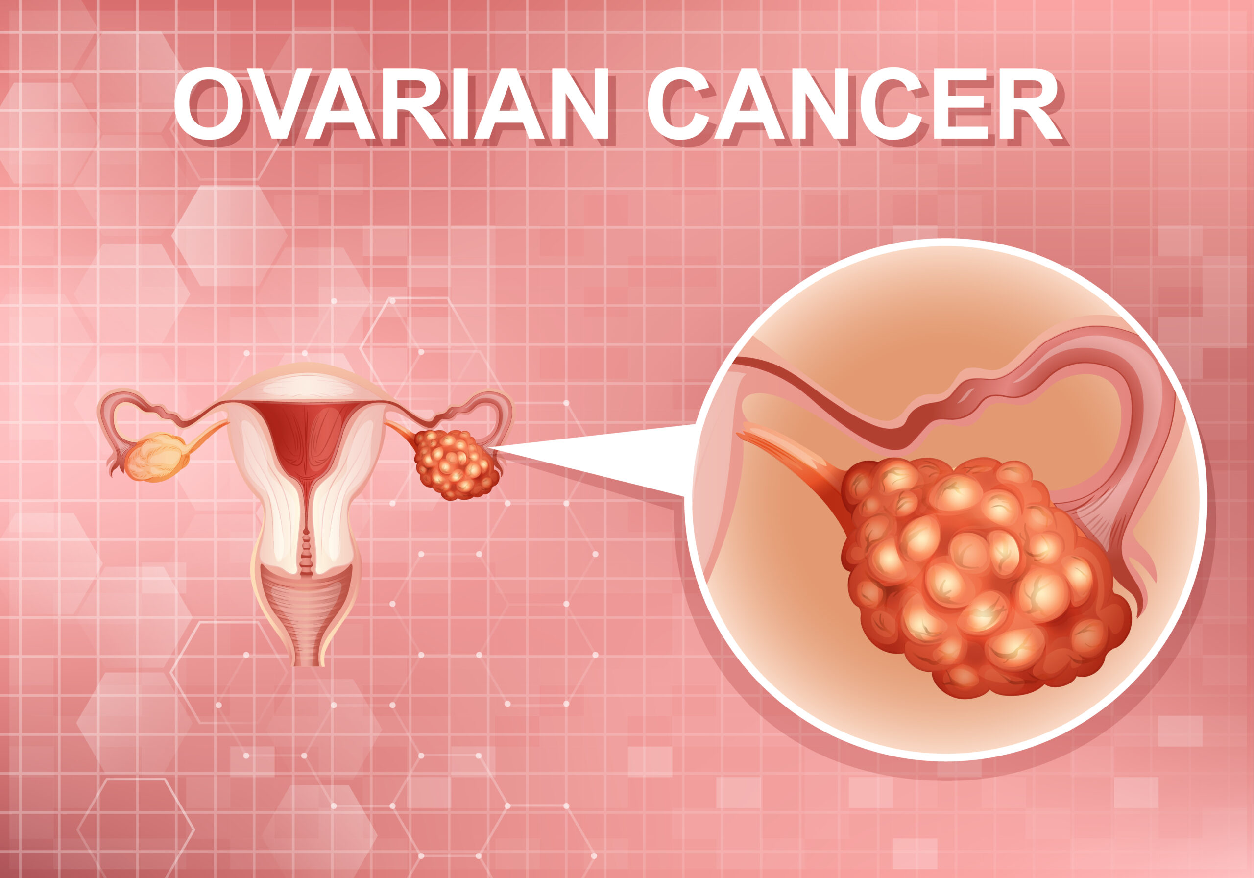 Ovarian Cancer: Causes, Early Symptoms & Prevention Tips