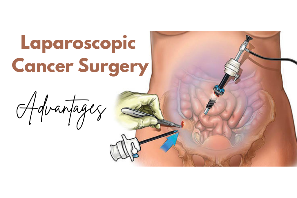 Laparoscopic Cancer Surgery: Modern Treatment Approach