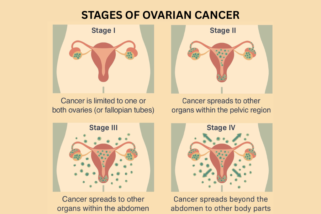 Ovarian Cancer Stages: Symptoms, Treatment & Survival Guide
