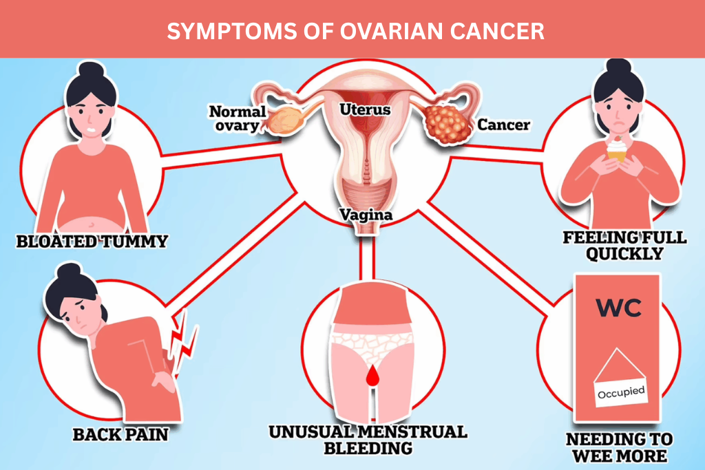 Ovarian Cancer: Causes, Early Symptoms & Prevention Tips
