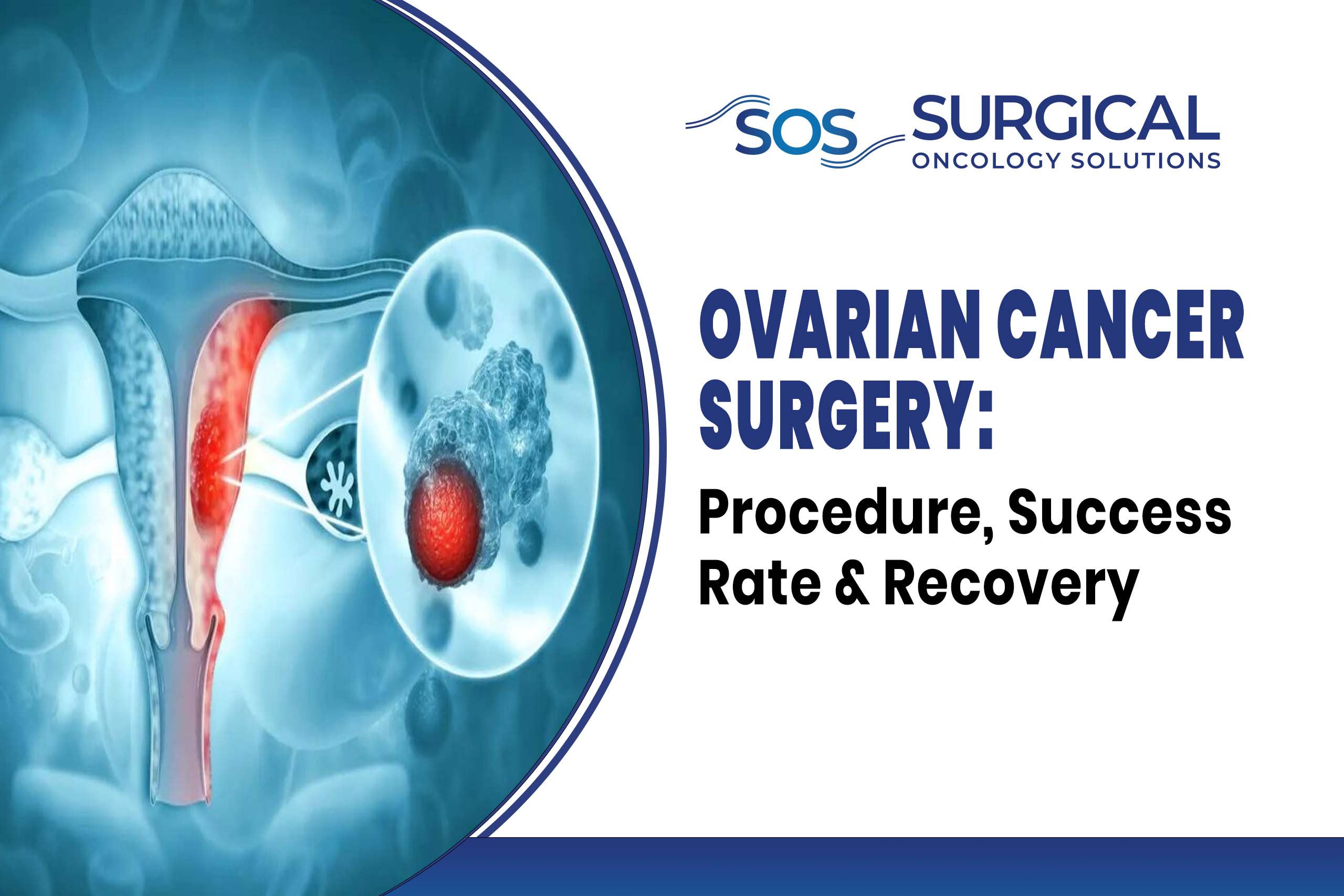 Ovarian Cancer Surgery: Procedure, Success Rate & Recovery