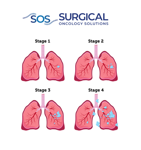 Lung Cancer Stages