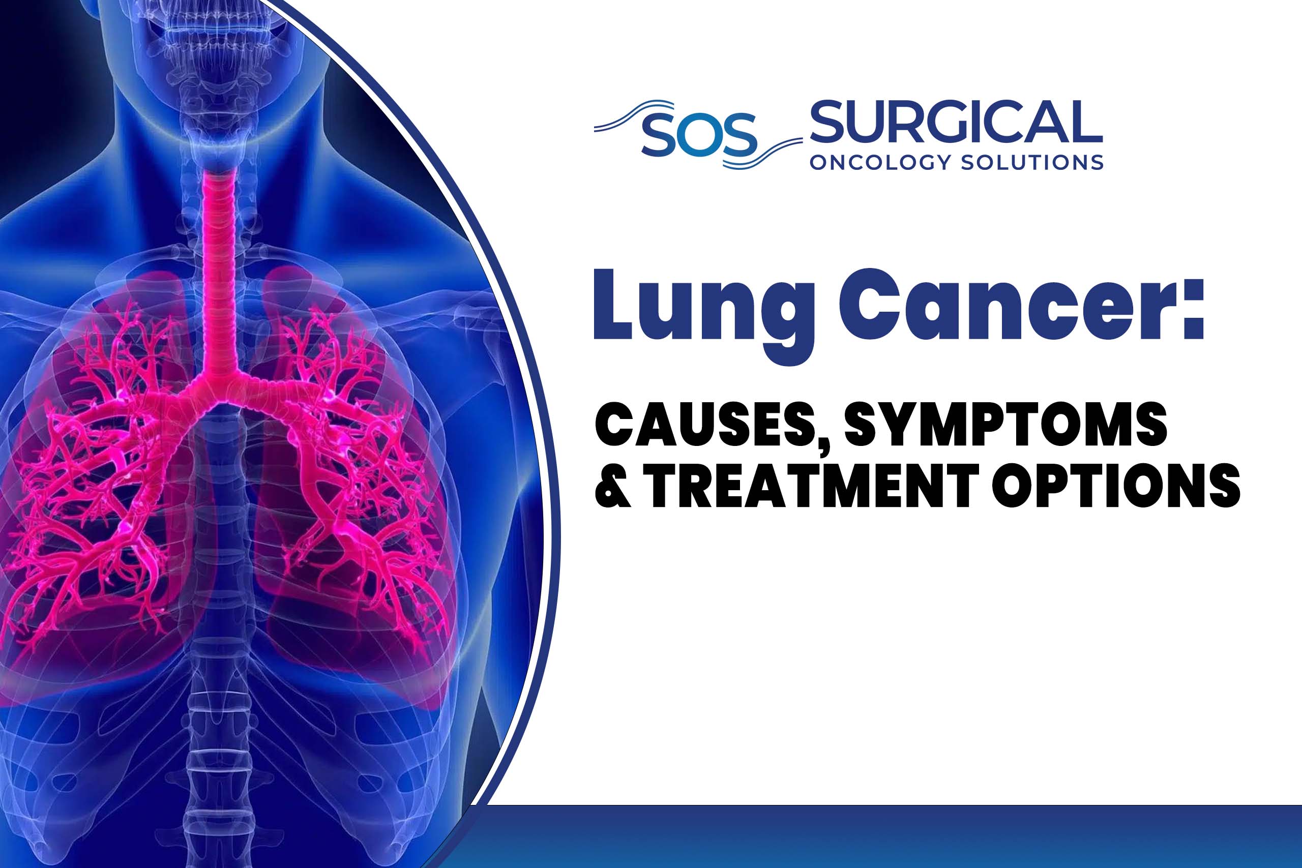 Lung Cancer: Causes, Symptoms & Treatment Options