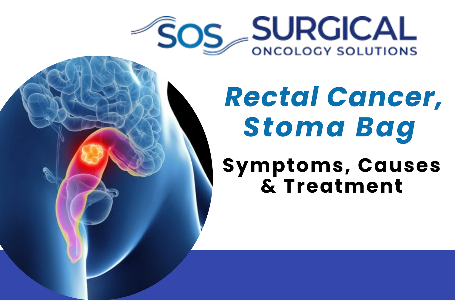 Do All Rectal Cancer Patients Need a Stoma Bag? Myths vs. Modern Reality