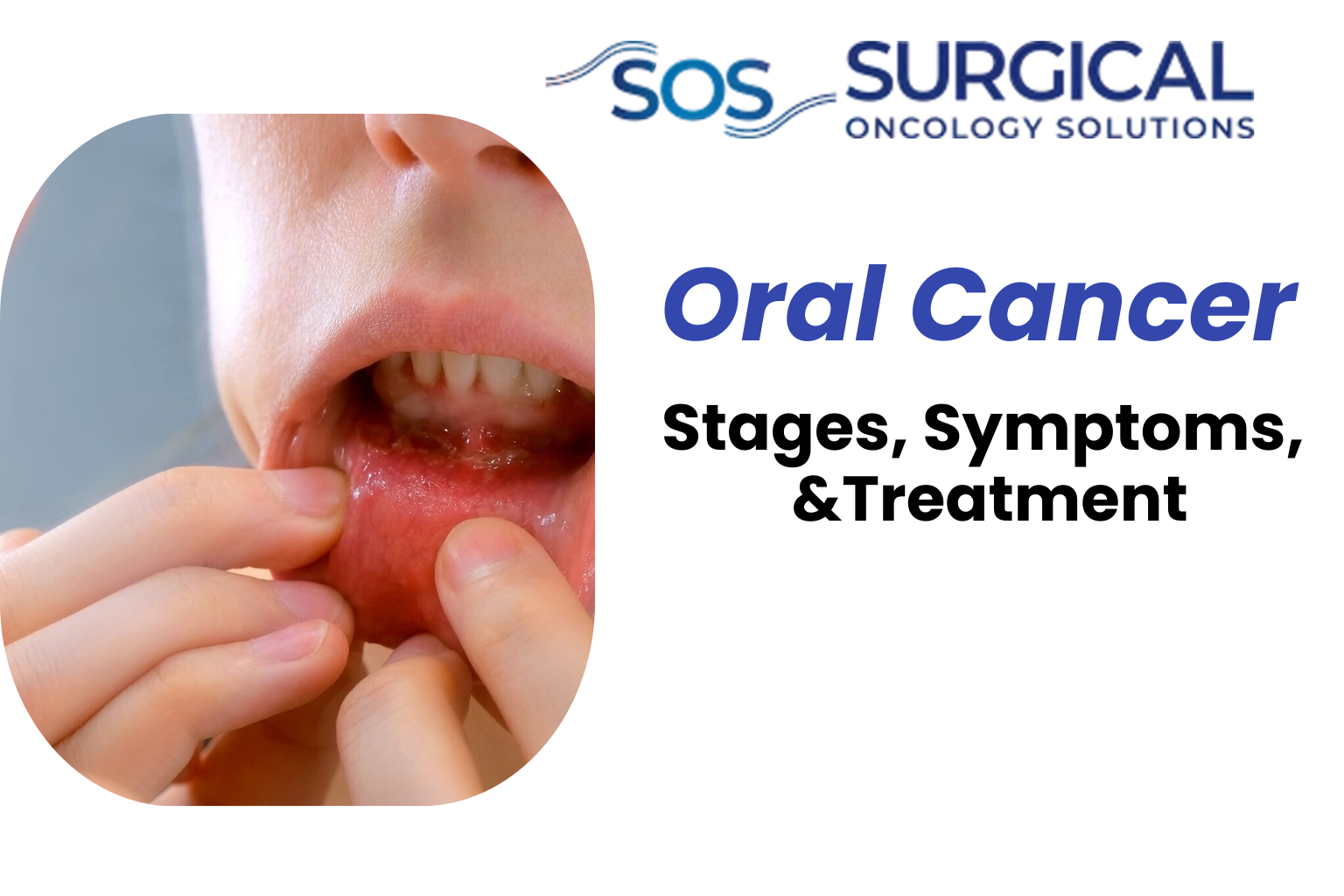 Oral Cancer: Early Signs, Causes & Treatment