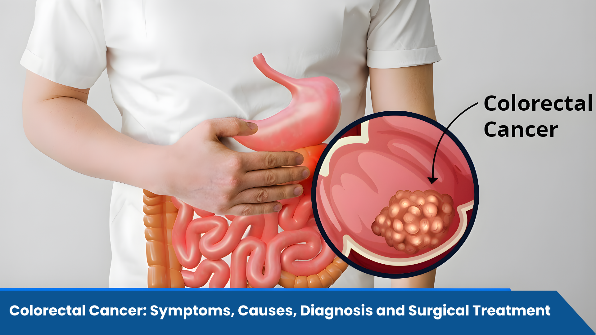 Colorectal Cancer: Symptoms, Causes, Diagnosis and Surgical Treatment